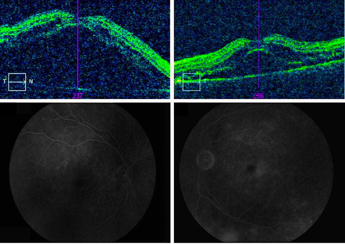 Vogt-Koyanagi-Harada disease