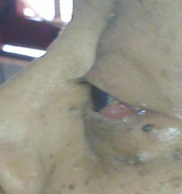 A 73-year-old man with mild proptosis of the left eye