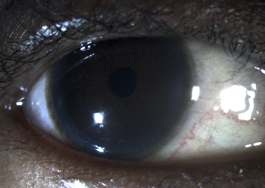 Primary meningococcal conjunctivitis: an unusual case of transmission by saliva