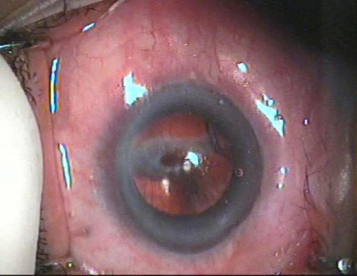 In-the-bag decentration of an intraocular lens in a patient with a tendency to hypertrophic scarring