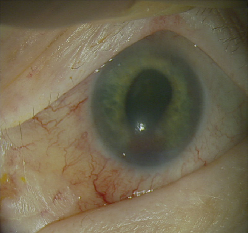 Preoperative photograph at the time of neovascular glaucoma diagnosis showing rubeosis iridis, hyphema, and exposed conjunctiva with keratinization