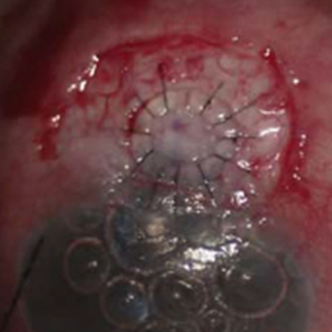 Surgical repair of a weakened scleral trabeculectomy flap using a corneal patch graft