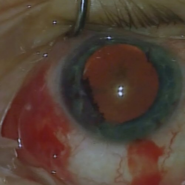 Image of the left eye during surgery showing spontaneous bleeding from multiple sites on the surface of the iris.