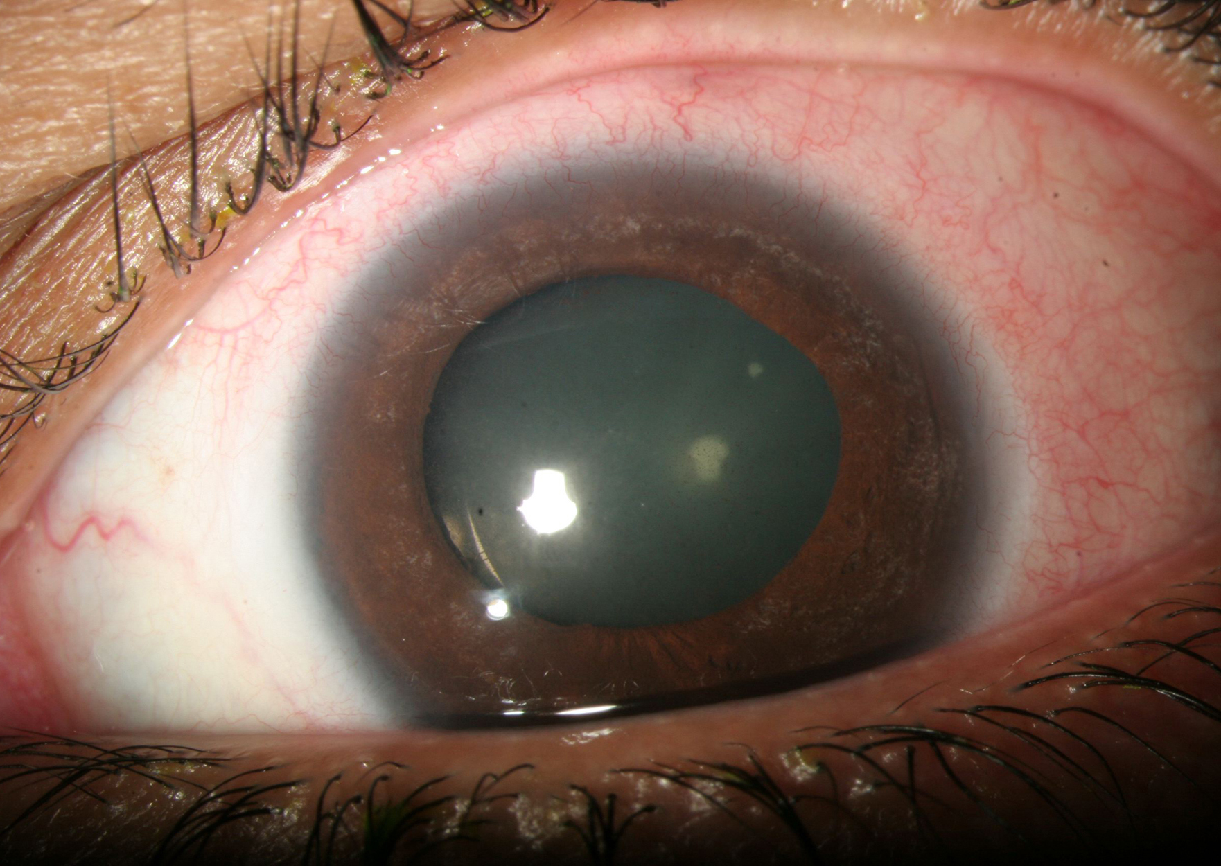 Anterior segment photo of the left eye showing a mid-dilated pupil (after management of the elevated intraocular pressure)