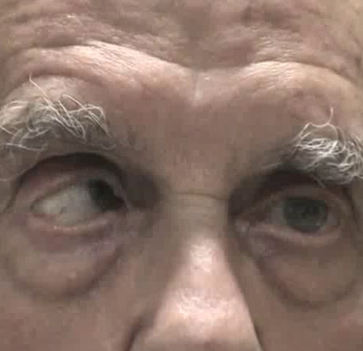 Sensorimotor examination revealing right hypertropia, right inferior oblique overaction and complete abduction palsy of the left eye