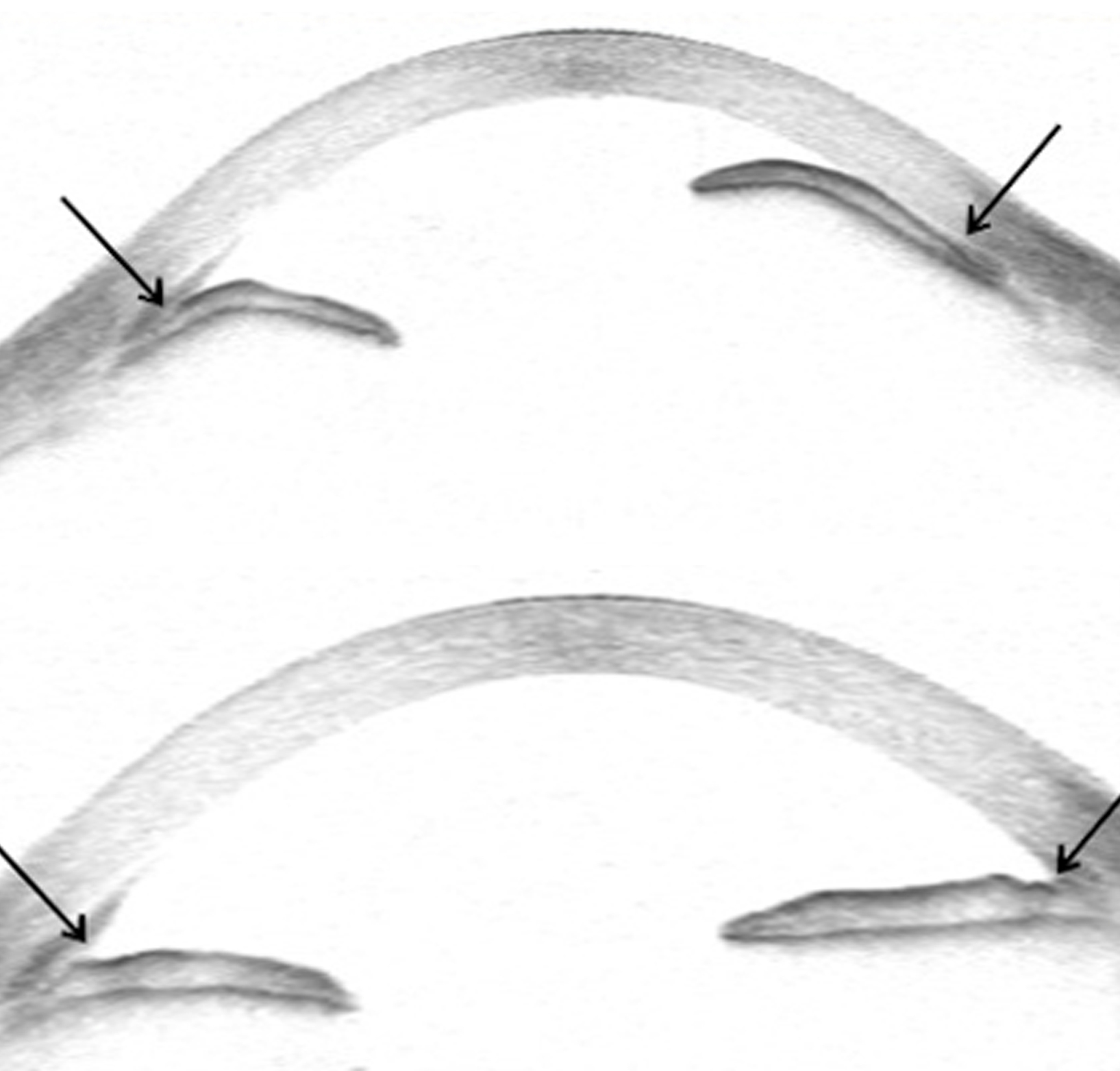 Top, Anterior segment optical coherence topography of patient with pupillary-block glaucoma with elevated intraocular pressure showing anterior bowing of the iris and closure of the iridocorneal angle (arrows). Bottom, After treatment, the anterior chamber has deepened with open angles and a flat iris contour (arrows).