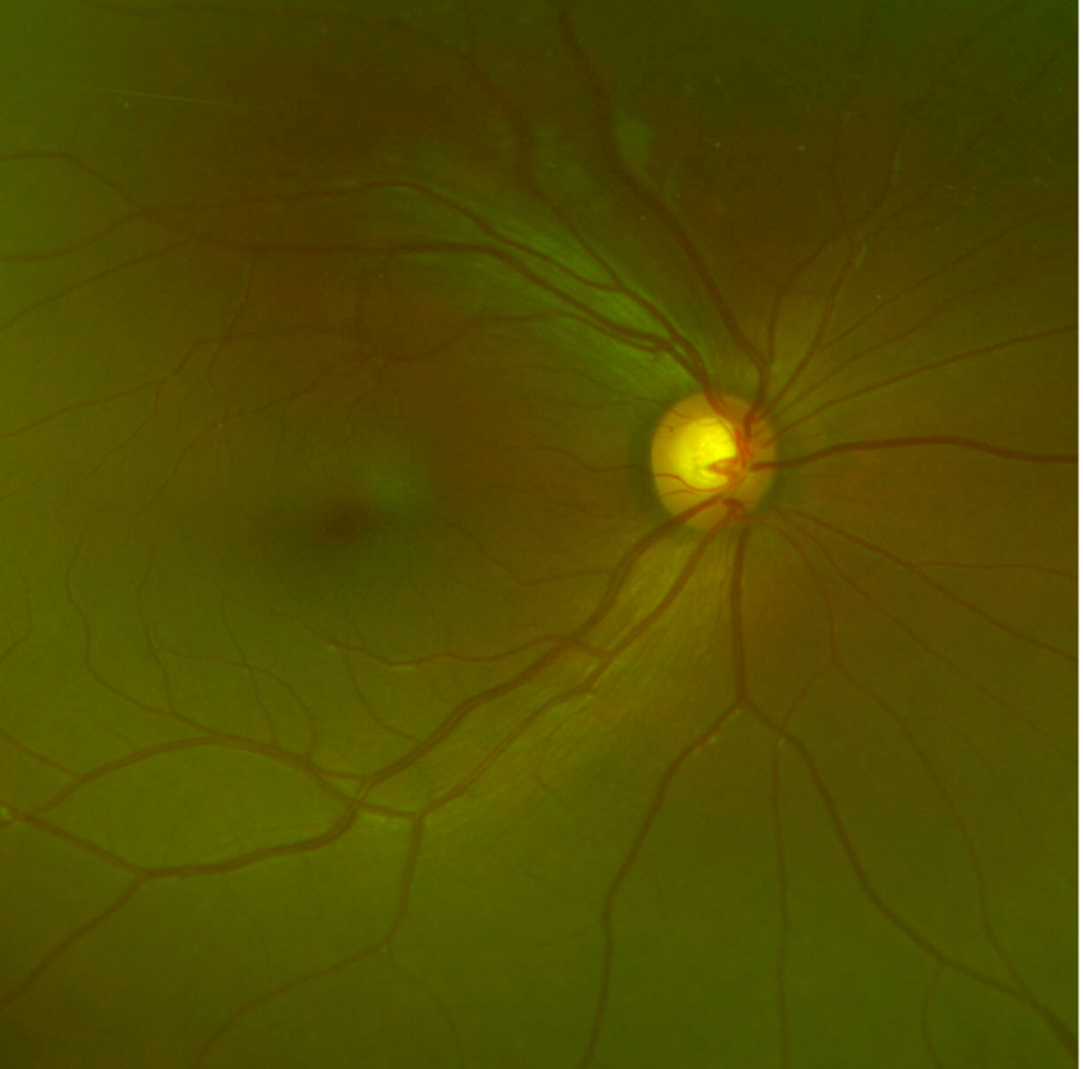 Color fundus photograph