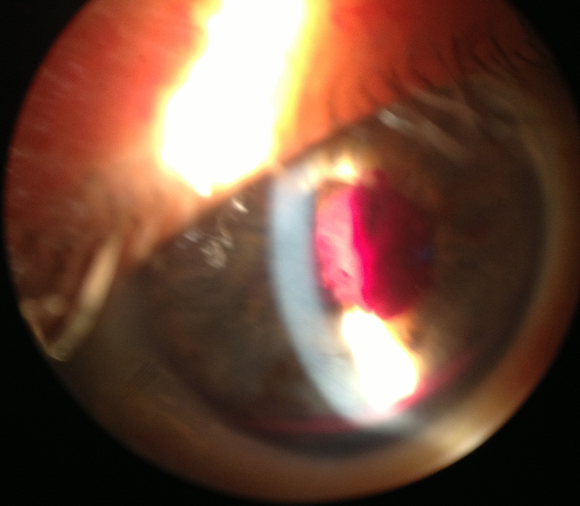 Bedside photography with a handheld portable slit-lamp showing a 1.5 mm crescent-shaped layering hyphema in the anterior chamber with a blood clot filling the pupillary aperture and obstructing the view to the posterior segment
