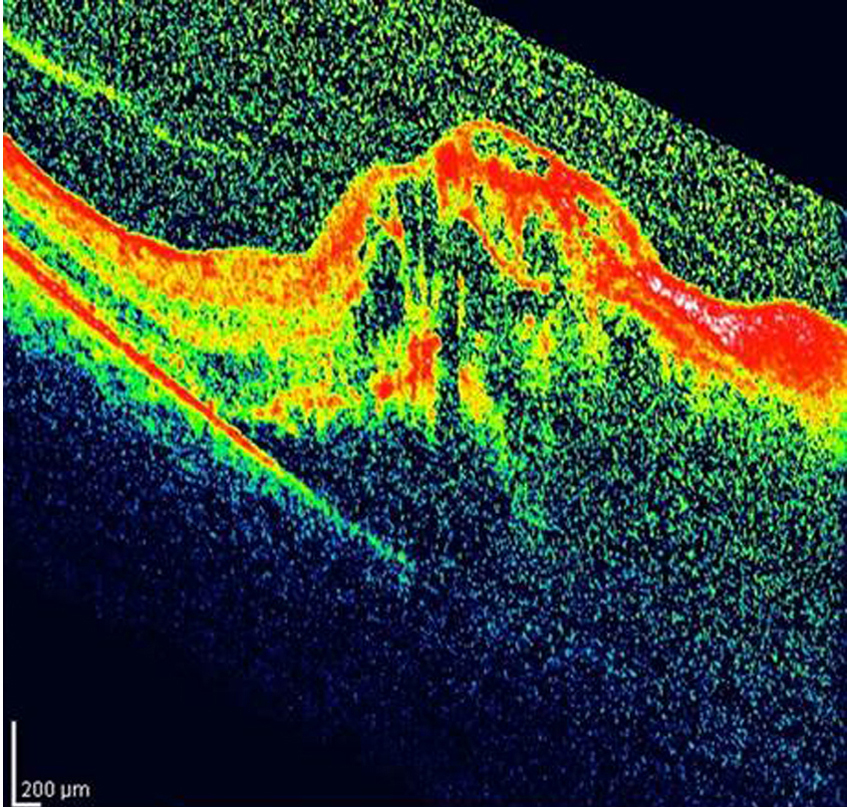 Color fundus photograph showing near total retinal detachment, with residual macular hard exudates