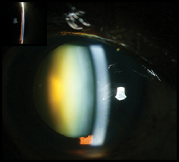 Preoperative slit-lamp photograph of the right eye of the patient showing shallow angle (inset) and a brunescent cataract