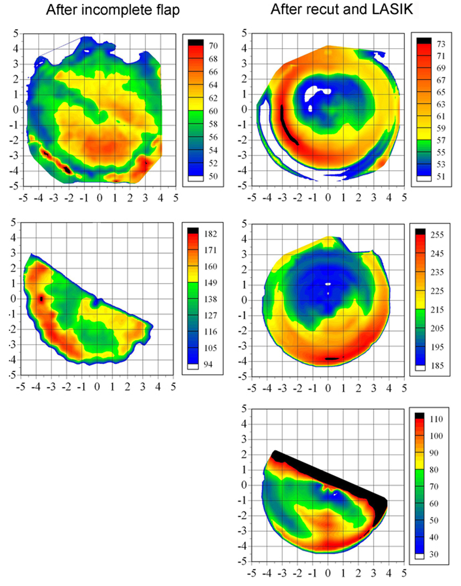 Artemis VHF digital ultrasound epithelial thickness maps (A), thickness of incomplete flap (B, left), secondary flap (B, right), and stromal thickness between incomplete and secondary flap interfaces (C). The epithelial thickness profile after the incomplete flap demonstrated a zone of thinning associated with the extent of the mechanical microkeratome cut. After the recut LASIK procedure, the epithelial thickness profile showed peripheral epithelial thickening, as expected after a hyperopic ablation. The flap thicknesses and the stromal thickness between them demonstrate the success of this treatment in avoiding interface crossover. Note that the difference in appearance between the two columns of maps is a result of the maps taken after the incomplete flap being produced using 18 B-scans and produced after the recut flap with 4 B-scans.