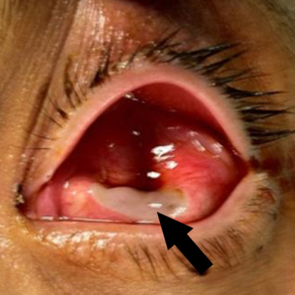 Patient’s left eye at presentation to the emergency department showing a deflated eye