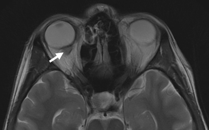 Axial T2-weighted MRI of patient 3 demonstrating a mass medial to the optic nerve and just posterior to the globe on the right side (white arrow)