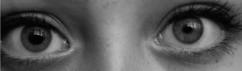 Variable anisocoria in a 15-year-old girl