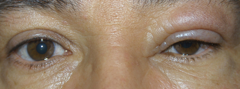 A 49-year-old man with left upper eyelid swelling of 14 months’ duration at presentation.