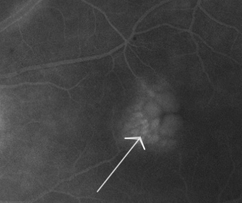 Cystoid macular edema associated with acitretin