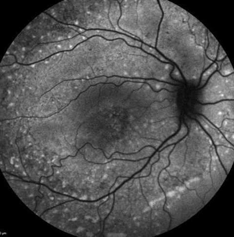 Fundus autofluorescence images of right eye showing multiple autofluorescent flecks extending to midperiphery.