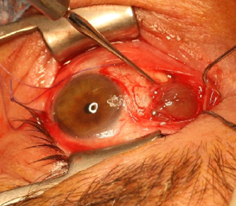 Intraoperative appearance of the chocolate-colored cyst filled with serosanguninous fluid, with strands of flaccid extraocular muscle straddling its surface