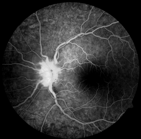 A 26-year-old man with a blind spot in his left eye