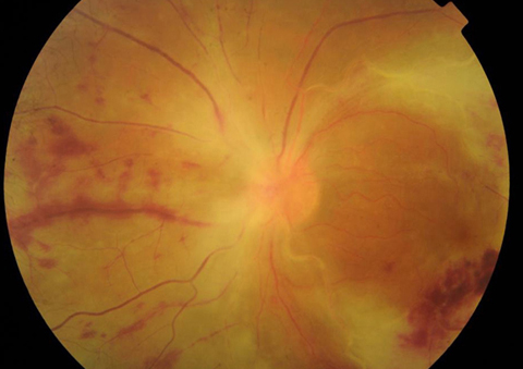 Fundus photograph of the left eye of a 30-year-old man diagnosed with acute retinal necrosis: retinal appearance at presentation: white confluent areas of necrosis overlie vascular arcades, hemorrhages, and vasculitis.