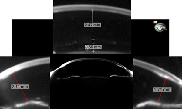 Toric phakic intraocular lens (IOL) distances from vital ocular structures (Sirius CSO; Costruzione Strumenti Oftalmici, Florence, Italy) showing the anterior segment of the patientâ€™s eye and illustrating the measured distance between the anterior surface of the phakic IOL and corneal endothelium (2.47 mm), distance between the posterior surface of the phakic IOL and anterior surface of the crystalline lens (0.56 mm), and critical distances (1.71 mm and 2.11 mm).