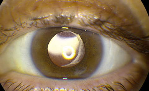 After placement of posterior chamber intraocular lens.