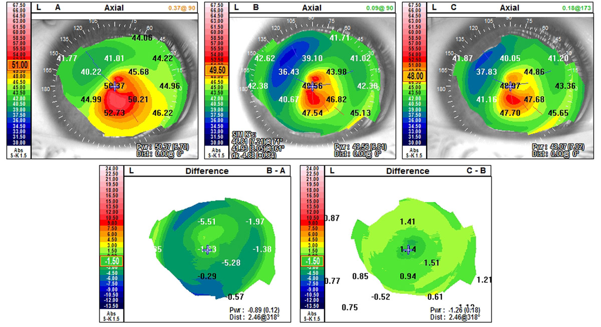 Corneal difference in the left eye (preoperative minus postoperative, after Intacs and collagen crosslinking procedures).