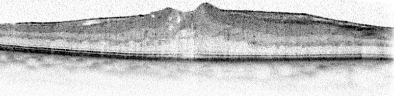 Optical coherence tomography (OCT) of the right eye of a 69-year-old woman confirming an epiretinal membrane, with some intraretinal fluid in the foveal region.