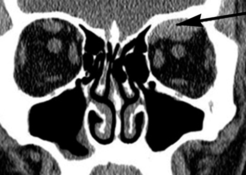 Noncontrast CT image (coronal view) of the left subperiosteal hematoma of superior orbit.