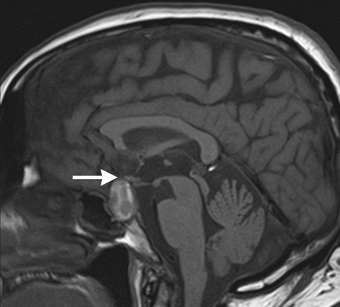 T1-weighted magnetic resonance imaging (MRI), sagittal view, showing hyperintense sellar mass (optic chiasm indicated by arrow).