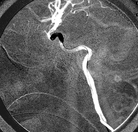 Lateral digital subtraction angiography image. A balloon-catheter has been temporarily inflated within the left cavernous ICA. Endovascular techniques are useful to control intra-operative hemorrhage in cases of vascular injury.