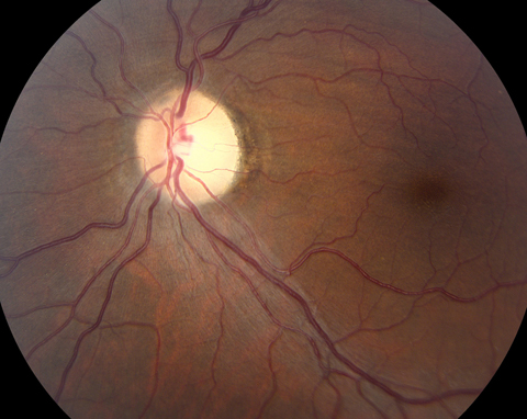 On examination, visual acuity was hand movements in the right eye and no light perception (NLP) in the left eye. There was no relative afferent papillary defect. Pupils were round and reactive to light. The anterior segments were normal. On dilated fundus examination, she was found to have a grossly swollen right optic disc and a pale left optic disc.