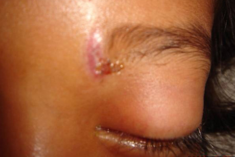 A 5-year-old girl with upper eyelid edema, at presentation.