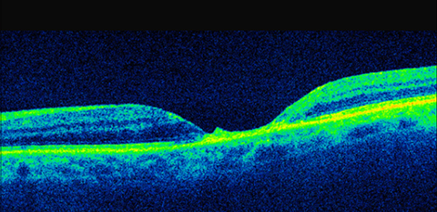 OCT image of the left eye after third foscarnet injection showing collapse of cystic spaces revealing almost complete loss of retinal tissues and destruction of RPE layer.