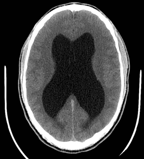 CT brain without contrast, axial view, revealing symmetric enlargement of the lateral ventricles.