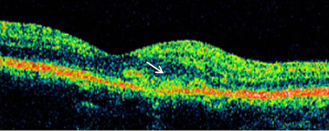 Left eye of patient with juxtafoveal choroidal neovascularization secondary to punctate inner choroidopathy: optical coherence tomography.