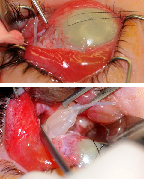 Supertemporal dissection exposing Ahmed valve tube buried deep in the orbit and diffusely cloudy cornea and removal of the Ahmed valve device showing associated purulent discharge.