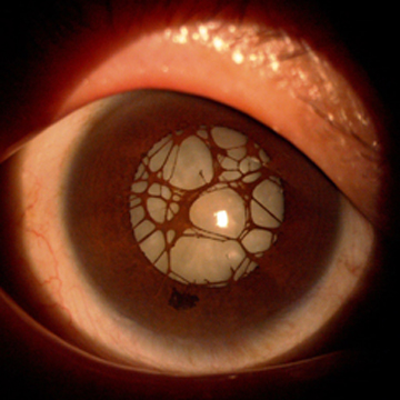 Right eye with persistent pupillary membrane and cataract.