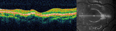 OCT of the left retina showing atrophy of the retina as well as the extent of the changes relative to the fovea. B, fundus photograph showing position of scan.