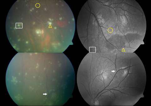 Inferior midperiphery of the left eye at the time of presentation showing disseminated discrete and multifocal chorioretinal lesions. Resolution of the inflammation in the same field after treatment. A preexisting RPE scar is shown in the field (yellow circle). Only trace RPE changes (white square) and vascular sheathing are seen at the sites of dense lesions after resolution; most of the lesions resolved without evidence of pigmentary changes or scarring. Superior midperiphery of the left eye at the time of presentation. Left eye after resolution of chorioretinal lesions showing no late scarring changes.