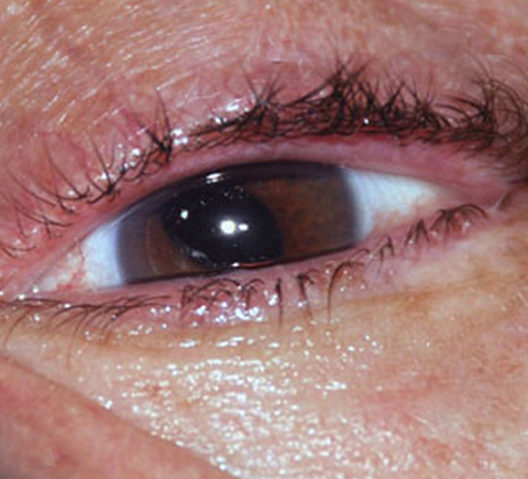 Photograph of patient's left eye at presentation showing significant pupillary capture of the nasal pupillary border.