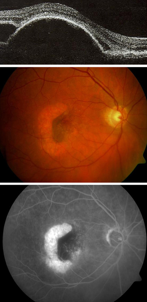 OCT of patient's right eye showing retinal pigment epithelial detachment before the ranibizumab injection; photograph of patient's right eye taken 30 minutes after the injection, showing retinal pigment epithelial tear; fluorescein angiogram of patientâ€™s right eye, taken 4 days after the injection, showing retinal pigment epithelial tear.