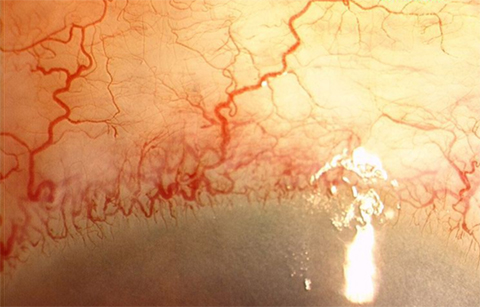 Preoperative photograph of the right eye of the patient with Sturge Weber syndrome showing conjunctival and episcleral vessels.
