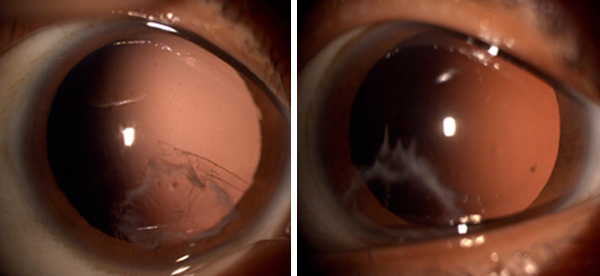 Photographs of the right and left eyes with the pupil dilated.