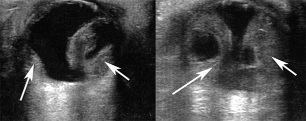 Transverse B-scan ultrasound of the right eye and left eye showing bilateral suprachoroidal hemorrhage (white arrows) with a serous component.