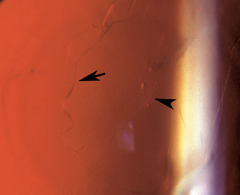 Left eye showing edge of floating anterior capsular fold on retro-illumination (arrow) and anterior subcapsular cataract opacity (arrowhead).