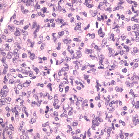 Numerous mitotic figures were noted, reflecting a highly proliferative lesion.