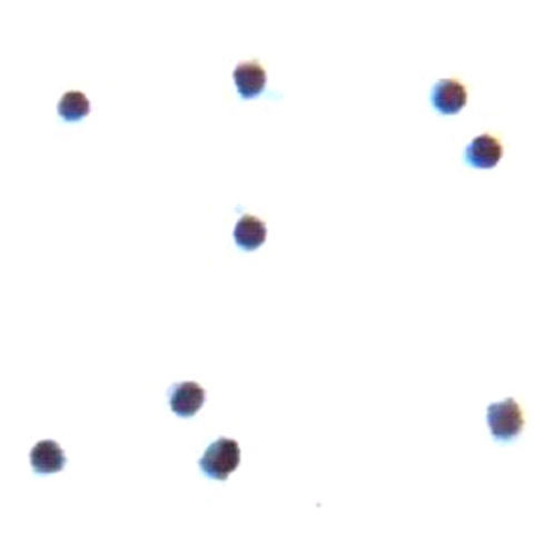 Cerebrospinal fluid showing presence of malignant lymphoma cells present.