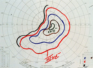 Goldmann visual field testing revealing a nasal island of field in the right eye