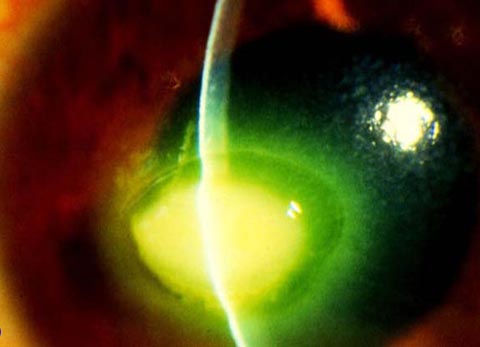 36 year old man with redness, discharge and blurred vision in the left eye